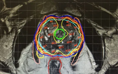3D Brachytherapy